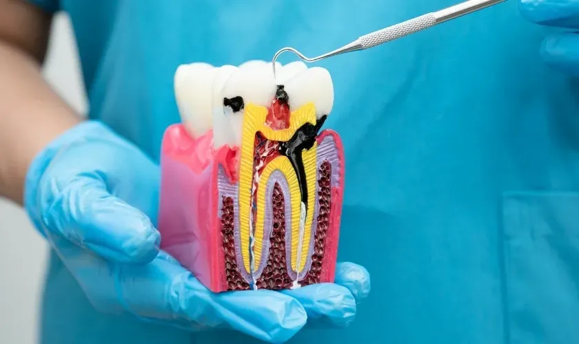 Afraid of Root Canals? Learn How Experts Make It Painless