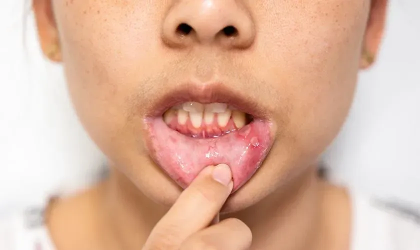 Foods & Drinks to Avoid If You Have Mouth Ulcers