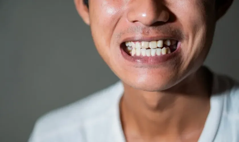 The Gap Between Your Dental Crown And Gums: How To Fix It?