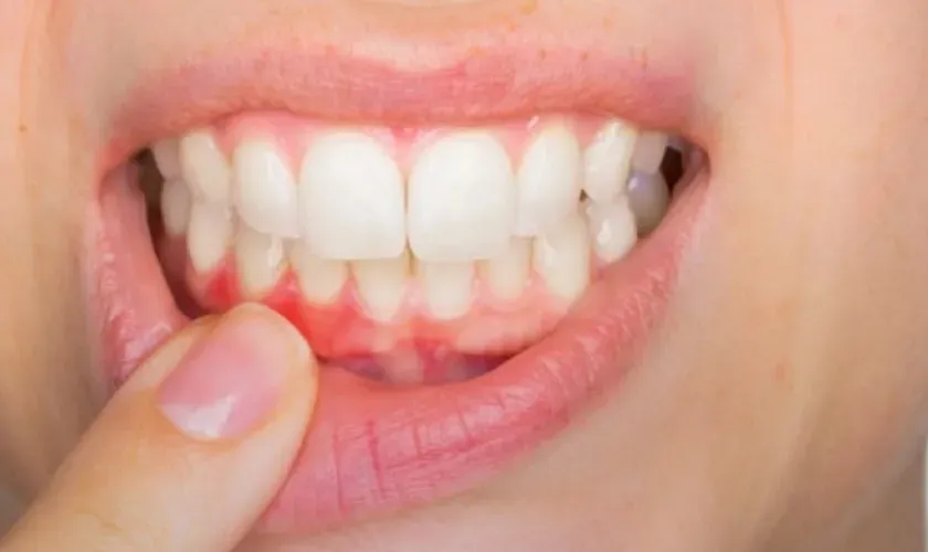 Periodontal Treatment Aftercare Tips in Fort Worth