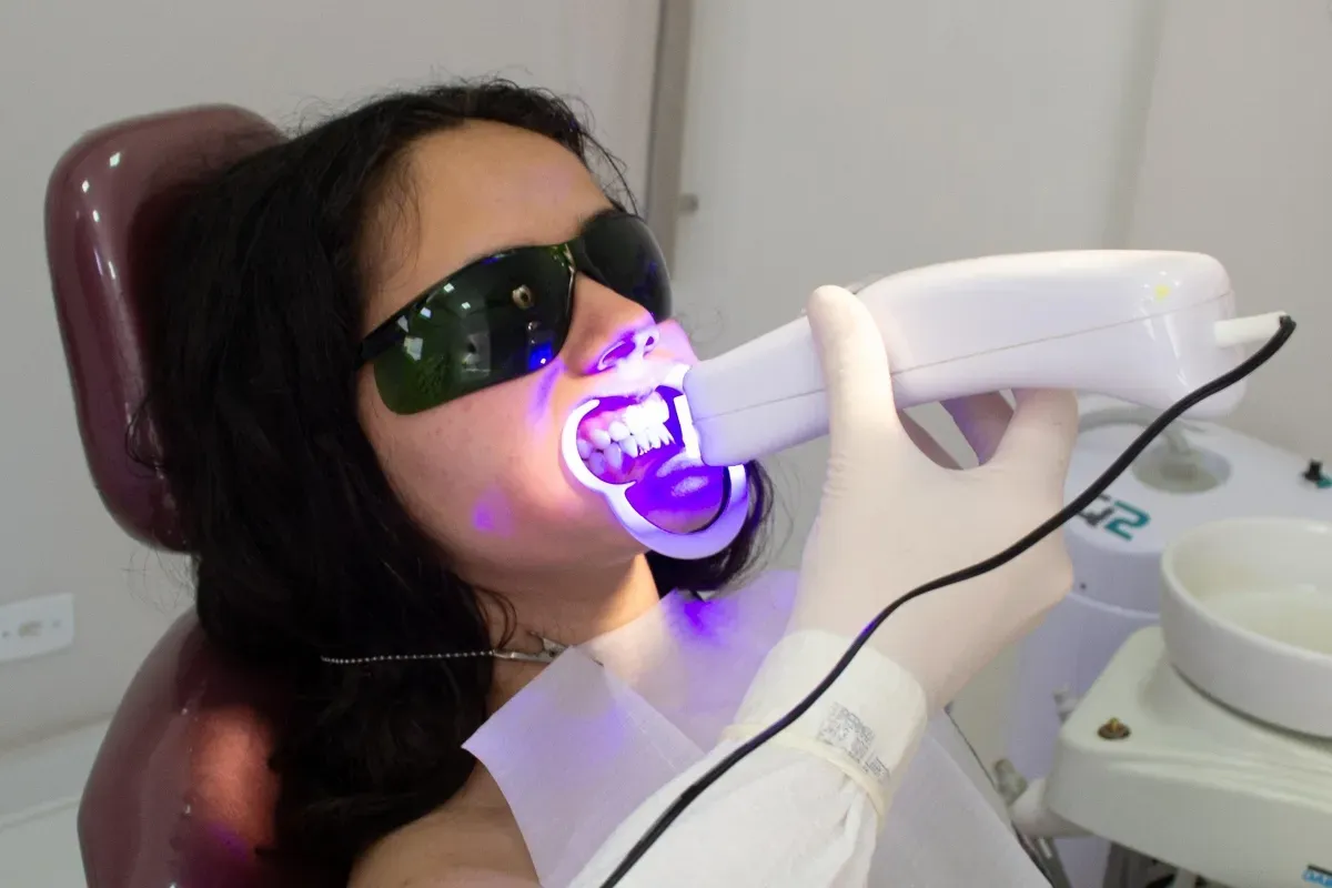 Teeth Whitening Before an Event: The Perfect Timing