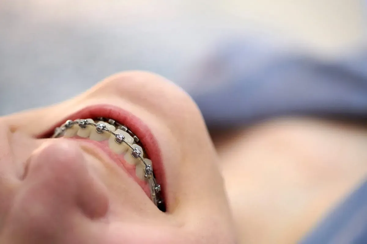 5 Common Braces Questions New Patients Ask Us First