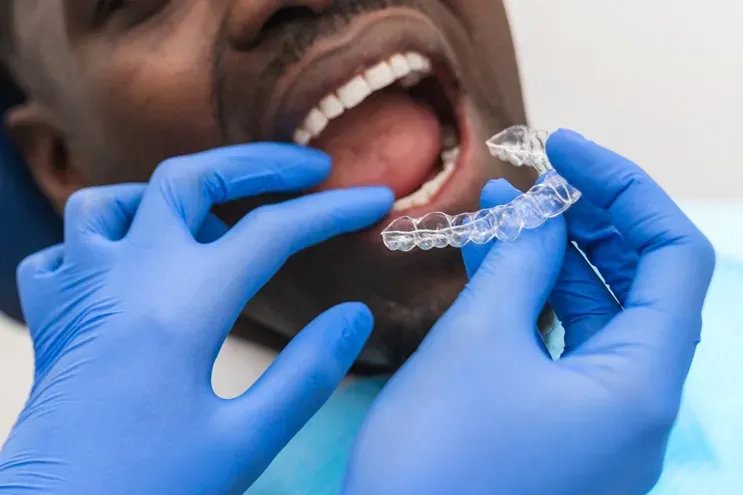 How Clear Aligners Help Close Gaps in Fort Worth