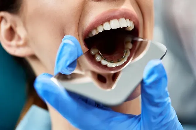 Do Tooth-Colored Fillings Stain Over Time? Insights