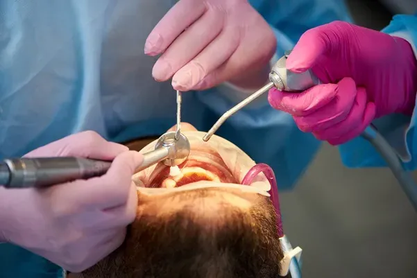 How to Recover Quickly from a Root Canal in Fort Worth