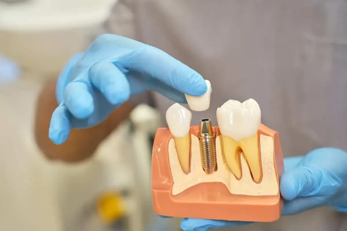 5 Dental Implant Myths That Might Be Holding You Back