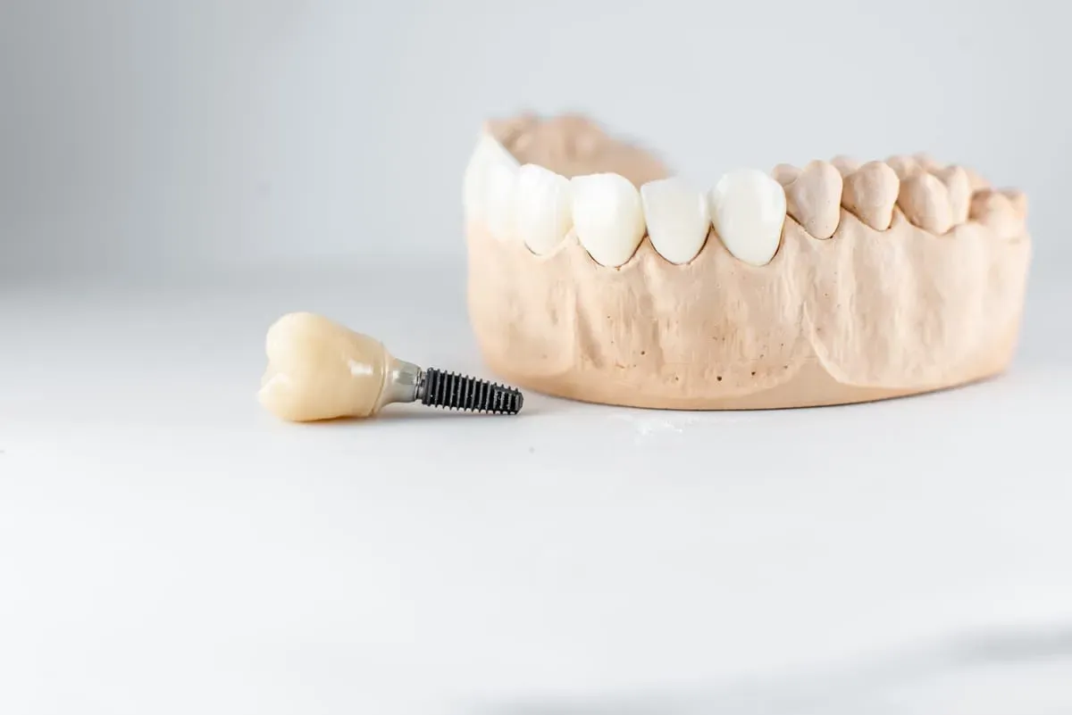 Dental Implants in North Richland Hills, TX
