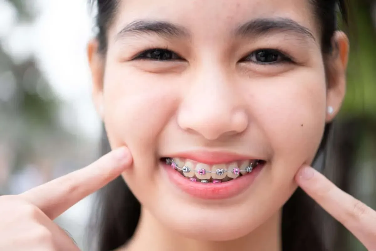Do Braces Results Last Forever, or Will Your Teeth Shift Back