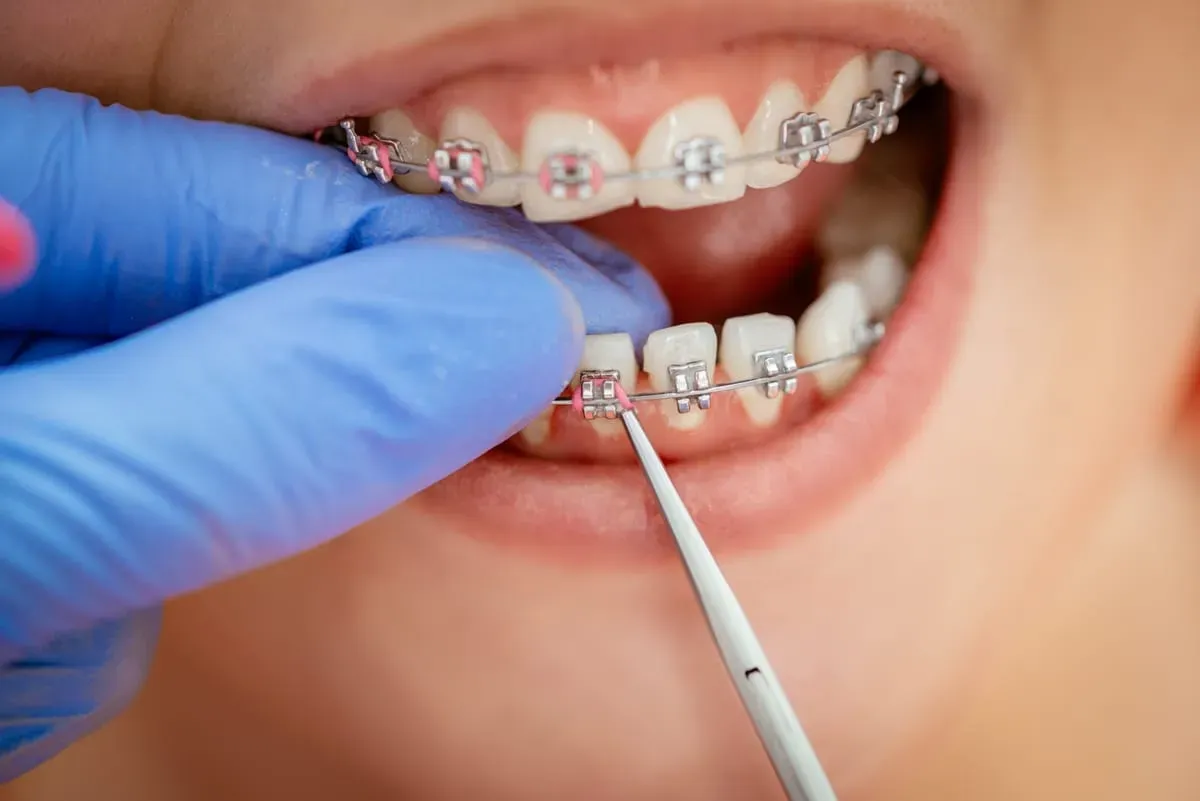 5 Questions We Hear Most About Restorative Dentistry