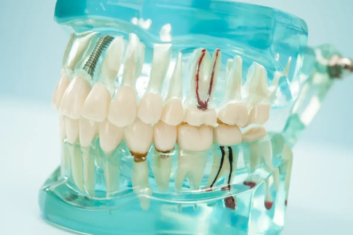 Understand Root Canal Failure Symptoms