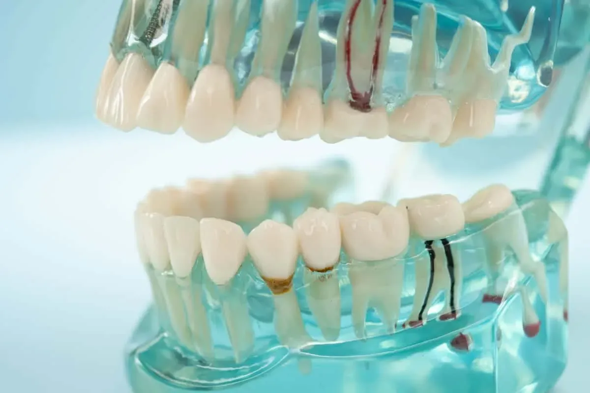 Root Canal vs. Extraction in Fort Worth, TX
