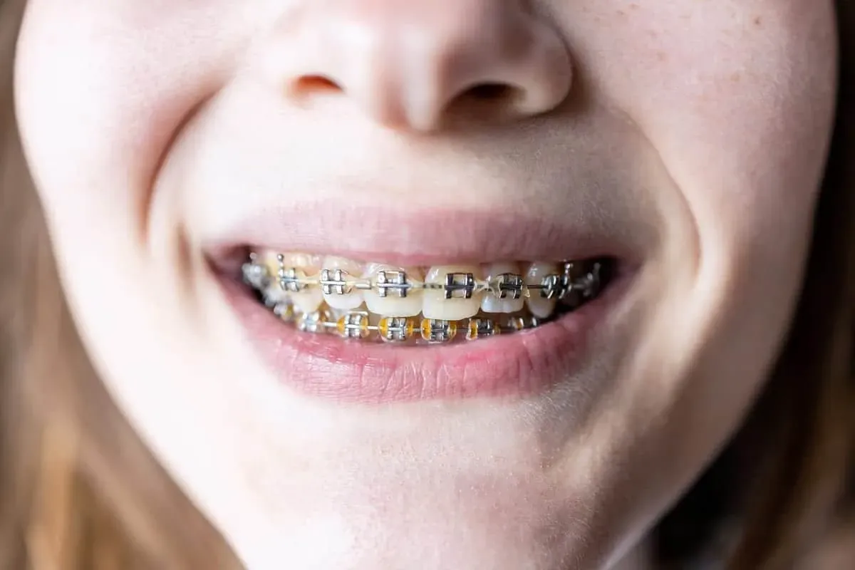Braces Removal Recovery Guide in Haslet, TX