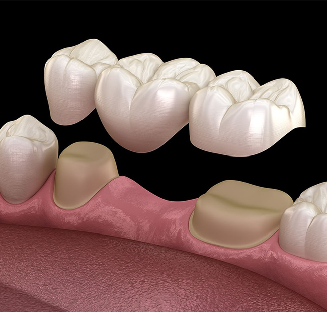 Dental Bridges Fort Worth TX - Flossophy Dental Studio