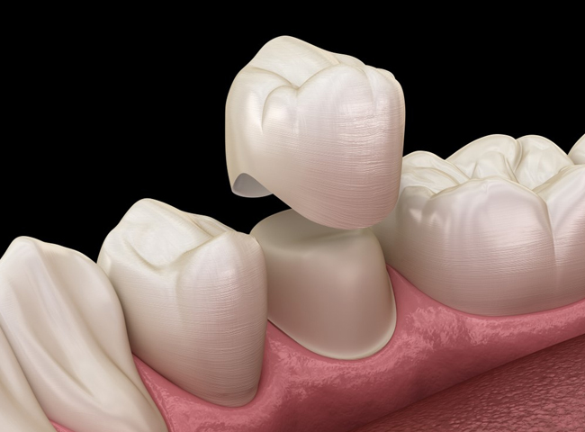 Dental Crowns Fort Worth TX - Flossophy Dental Studio