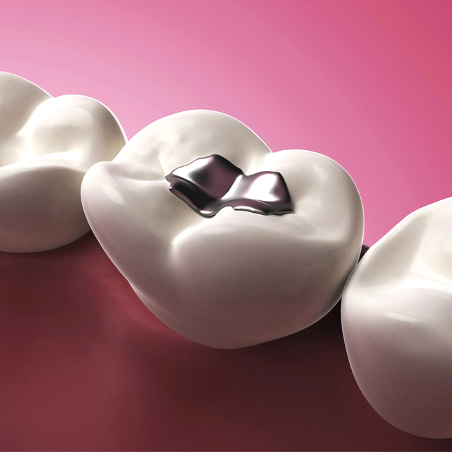 Dental Fillings Fort Worth TX - Flossophy Dental Studio