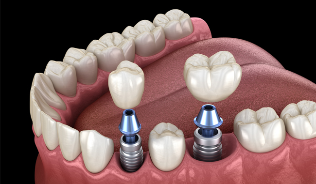 Dental Implant Fort Worth TX - Flossophy Dental Studio