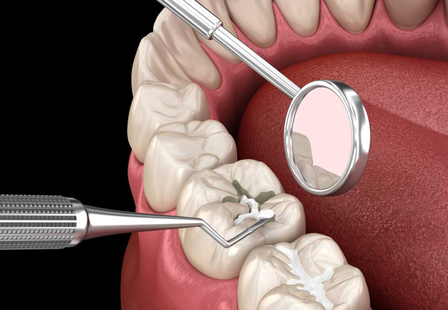 Dental Sealants Fort Worth TX - Flossophy Dental Studio