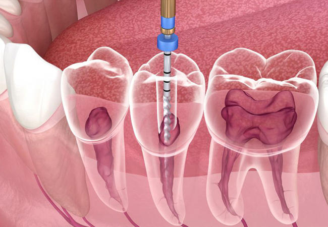 Endodontic Retreatment Fort Worth TX - Flossophy Dental Studio