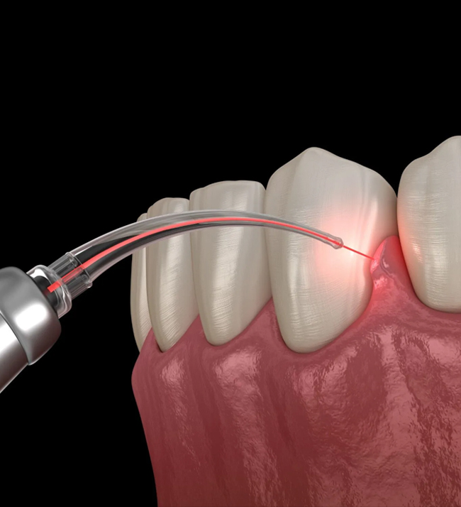 Laser gum Treatment Fort Worth TX - Flossophy Dental Studio