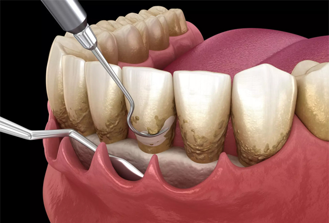 periodontal treatment fort worth - Gum disease treatment fort worth