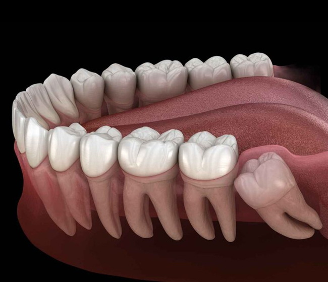 Tooth Extractions Fort Worth TX - Flossophy Dental Studio