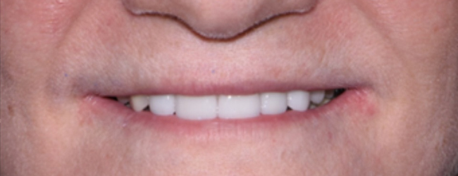 Veneers After Fort Worth TX - Flossophy Dental Studio