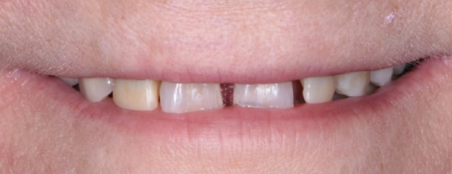 Veneers Before Fort Worth TX - Flossophy Dental Studio