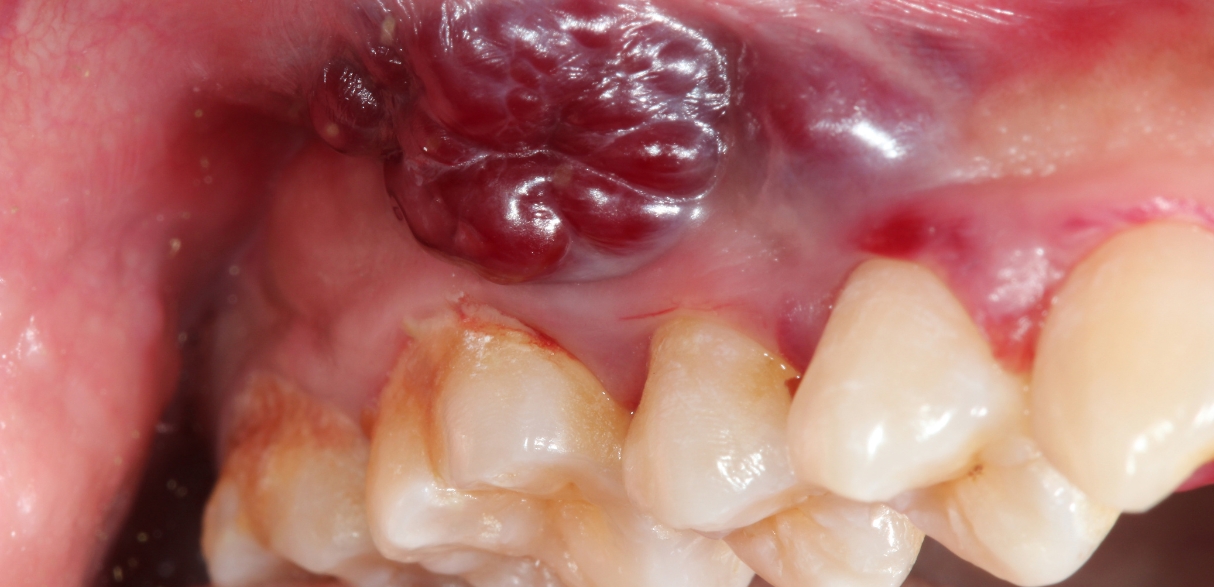 Leading the Way in Oral Cancer Screening
