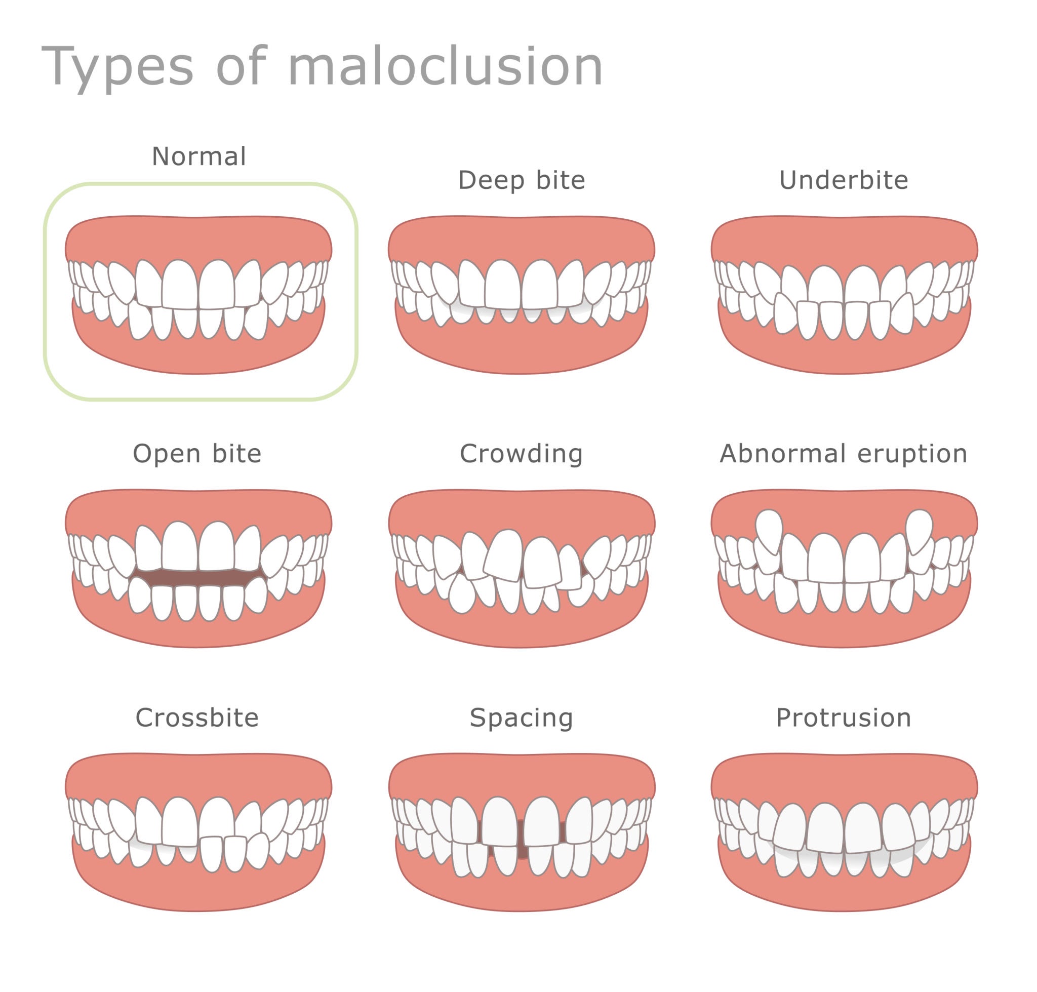 Types of malocclusion dental illustration. The illustration shows different types of human malocclusion.